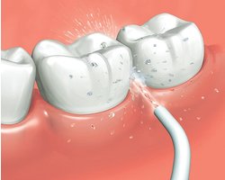 Vervangende Mondstukken voor Monddouche - 2-Pack